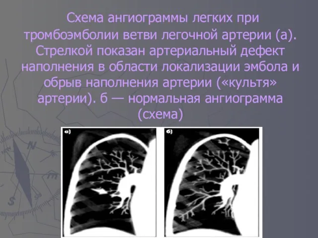 Схема ангиограммы легких при тромбоэмболии ветви легочной артерии (а). Стрелкой показан артериальный