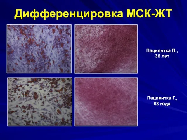 Дифференцировка МСК-ЖТ Пациентка П., 36 лет Пациентка Г., 63 года