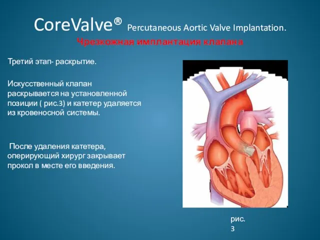 CoreValve® Percutaneous Aortic Valve Implantation. Чрезкожная имплантация клапана Третий этап- раскрытие. Искусственный