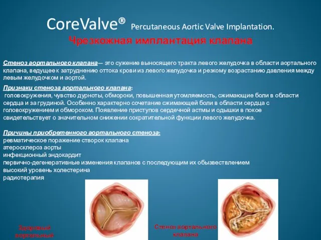 CoreValve® Percutaneous Aortic Valve Implantation. Чрезкожная имплантация клапана Стеноз аортального клапана— это