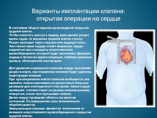 Варианты имплантации клапана: открытая операция на сердце В состояние общего наркоза производится