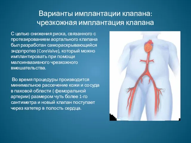 Варианты имплантации клапана: чрезкожная имплантация клапана С целью снижения риска, связанного с