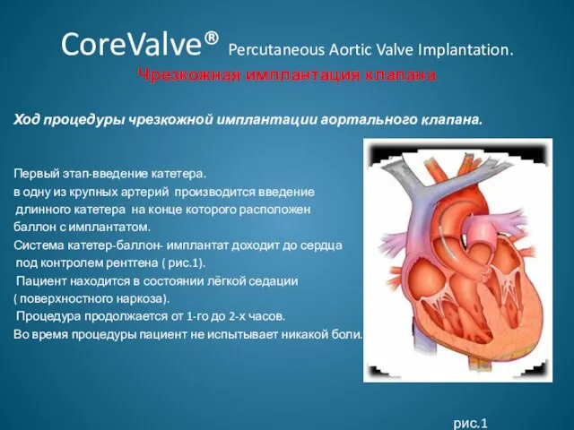 CoreValve® Percutaneous Aortic Valve Implantation. Чрезкожная имплантация клапана Ход процедуры чрезкожной имплантации