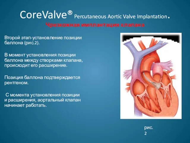 CoreValve® Percutaneous Aortic Valve Implantation. Чрезкожная имплантация клапана Второй этап-установление позиции баллона