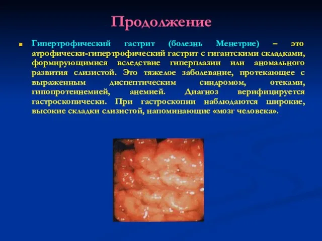 Продолжение Гипертрофический гастрит (болезнь Менетрие) – это атрофически-гипертрофический гастрит с гигантскими складками,