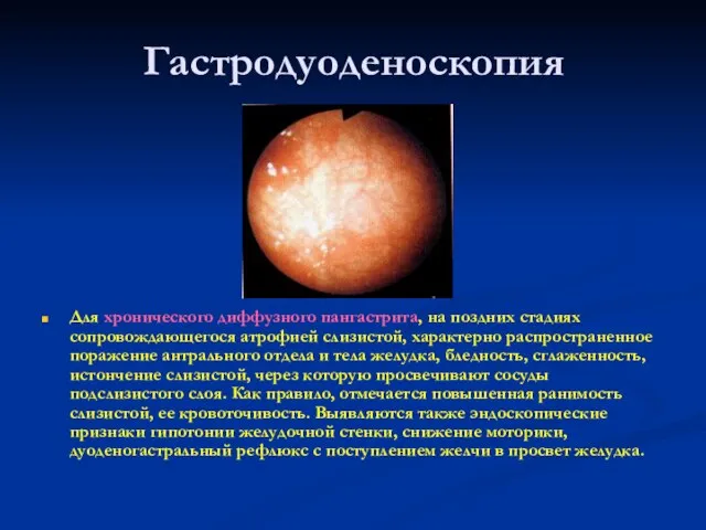 Гастродуоденоскопия Для хронического диффузного пангастрита, на поздних стадиях сопровождающегося атрофией слизистой, характерно