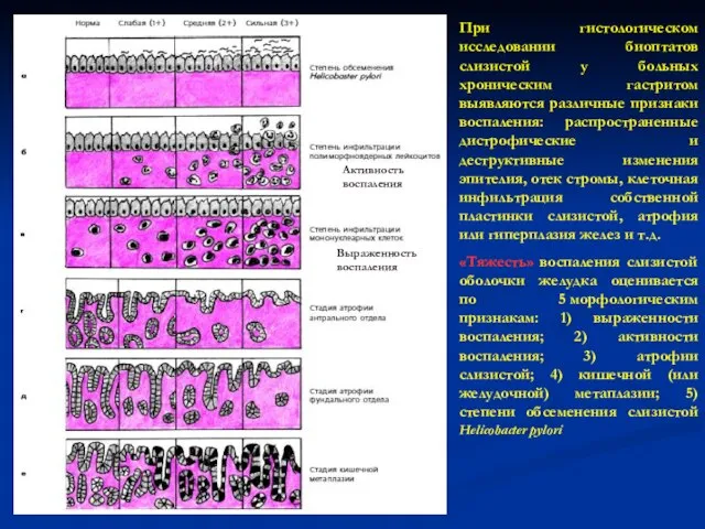 При гистологическом исследовании биоптатов слизистой у больных хроническим гастритом выявляются различные признаки