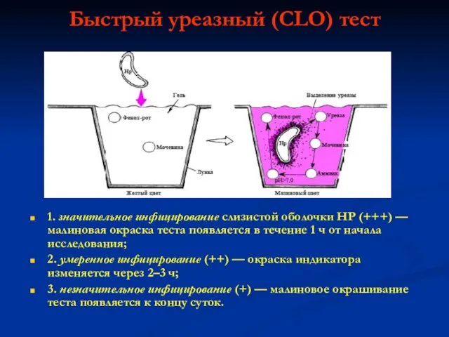 Быстрый уреазный (CLO) тест 1. значительное инфицирование слизистой оболочки НР (+++) —