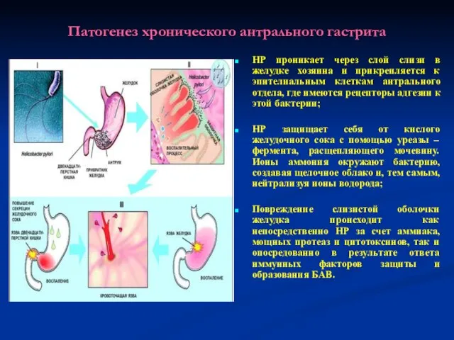 Патогенез хронического антрального гастрита HР проникает через слой слизи в желудке хозяина