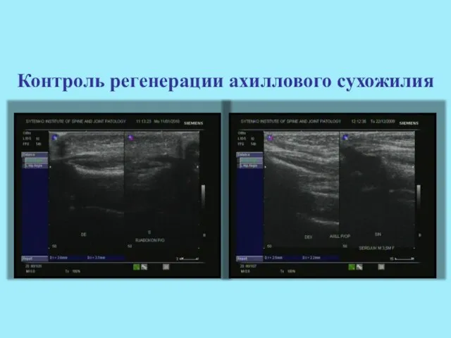 Контроль регенерации ахиллового сухожилия
