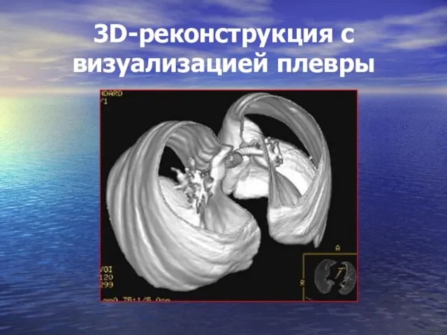 3D-реконструкция с визуализацией плевры