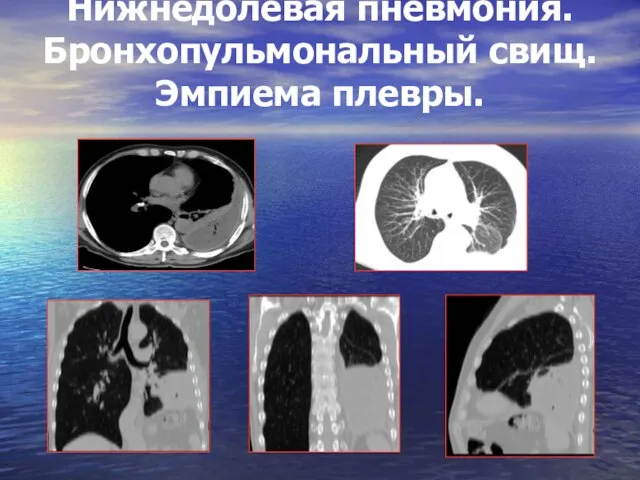 Нижнедолевая пневмония. Бронхопульмональный свищ. Эмпиема плевры.