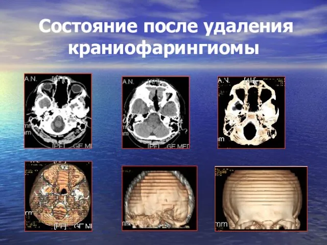 Состояние после удаления краниофарингиомы