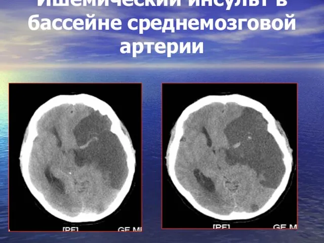 Ишемический инсульт в бассейне среднемозговой артерии