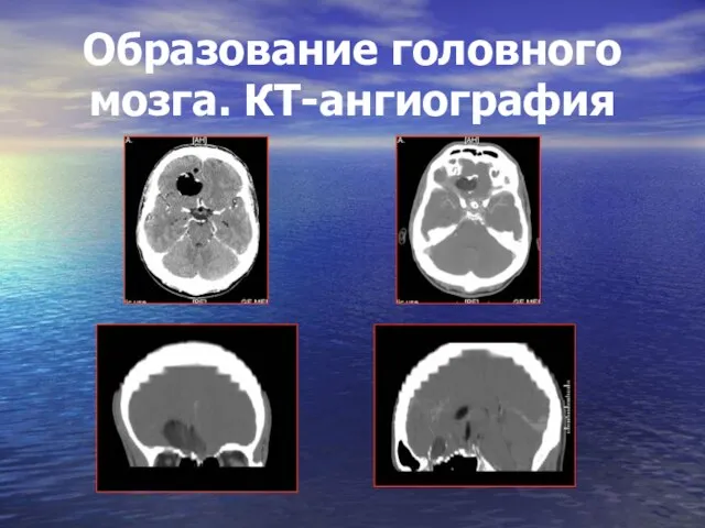 Образование головного мозга. КТ-ангиография