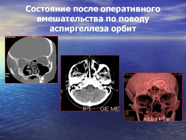 Состояние после оперативного вмешательства по поводу аспиргеллеза орбит