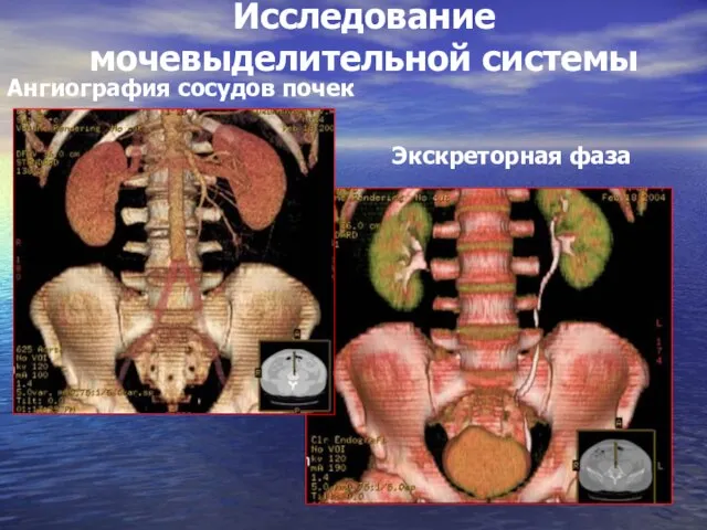 Экскреторная фаза Исследование мочевыделительной системы Ангиография сосудов почек