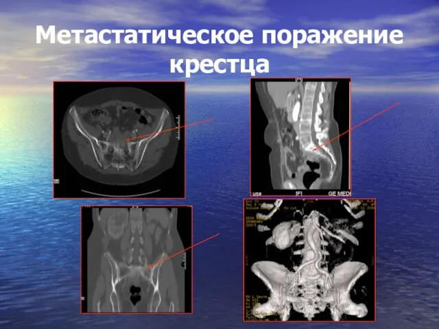 Метастатическое поражение крестца