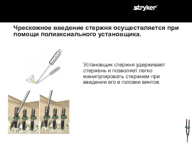 Чрескожное введение стержня осуществляется при помощи полиаксиального установщика. Установщик стержня удерживает стержень