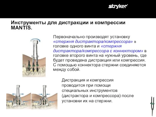 Инструменты для дистракции и компрессии MANTIS. Первоначально производят установку «стержня дистрактора/компрессора» в