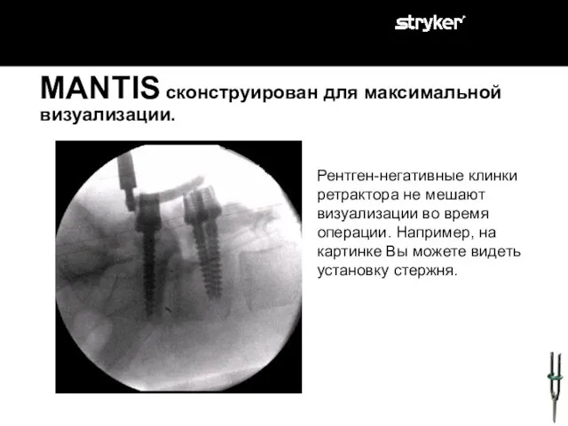 MANTIS сконструирован для максимальной визуализации. Рентген-негативные клинки ретрактора не мешают визуализации во