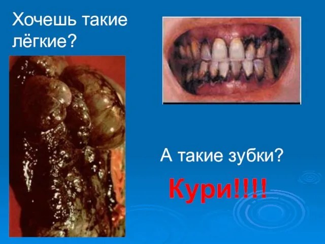 Хочешь такие лёгкие? А такие зубки? Кури!!!!