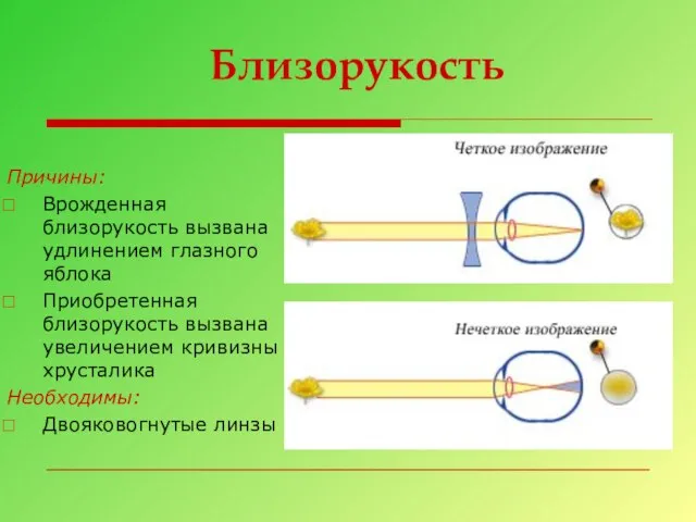 Близорукость Причины: Врожденная близорукость вызвана удлинением глазного яблока Приобретенная близорукость вызвана увеличением