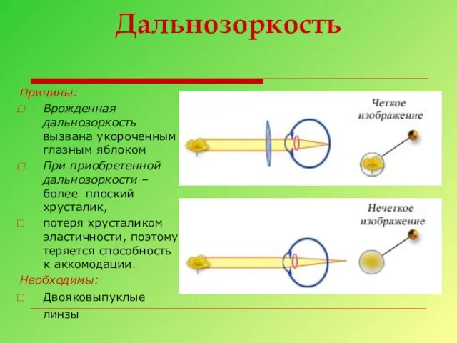 Дальнозоркость Причины: Врожденная дальнозоркость вызвана укороченным глазным яблоком При приобретенной дальнозоркости –