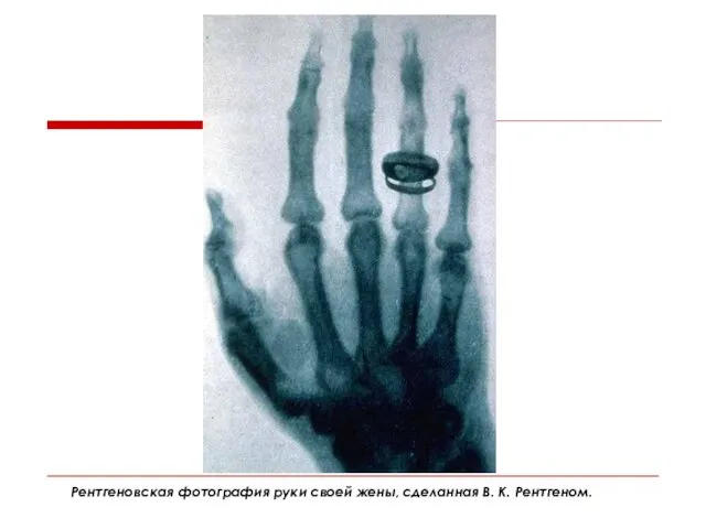Рентгеновская фотография руки своей жены, сделанная В. К. Рентгеном.