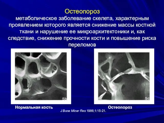 Остеопороз метаболическое заболевание скелета, характерным проявлением которого является снижение массы костной ткани