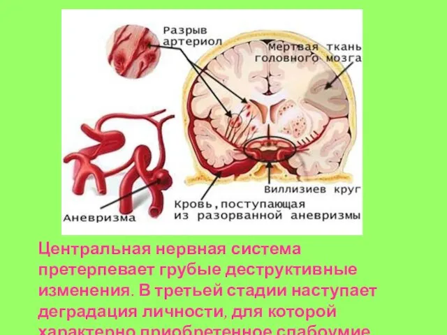 Центральная нервная система претерпевает грубые деструктивные изменения. В третьей стадии наступает деградация