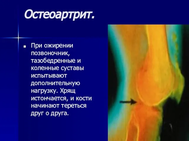 Остеоартрит. При ожирении позвоночник, тазобедренные и коленные суставы испытывают дополнительную нагрузку. Хрящ