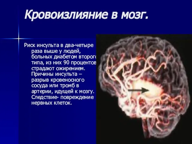 Кровоизлияние в мозг. Риск инсульта в два-четыре раза выше у людей, больных