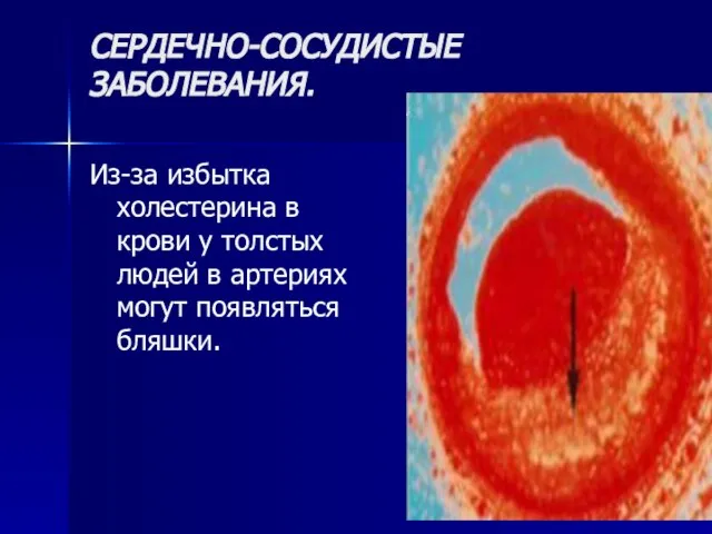 СЕРДЕЧНО-СОСУДИСТЫЕ ЗАБОЛЕВАНИЯ. Из-за избытка холестерина в крови у толстых людей в артериях могут появляться бляшки.