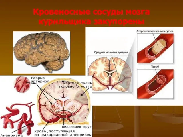 Кровеносные сосуды мозга курильщика закупорены