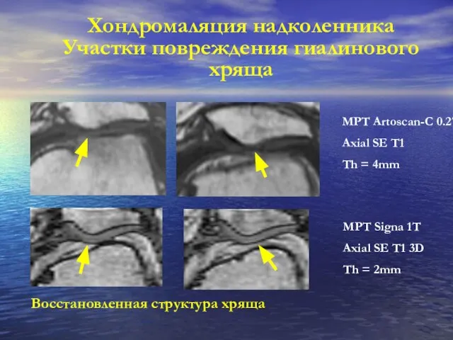 Хондромаляция надколенника Участки повреждения гиалинового хряща Восстановленная структура хряща МРТ Artoscan-C 0.2T