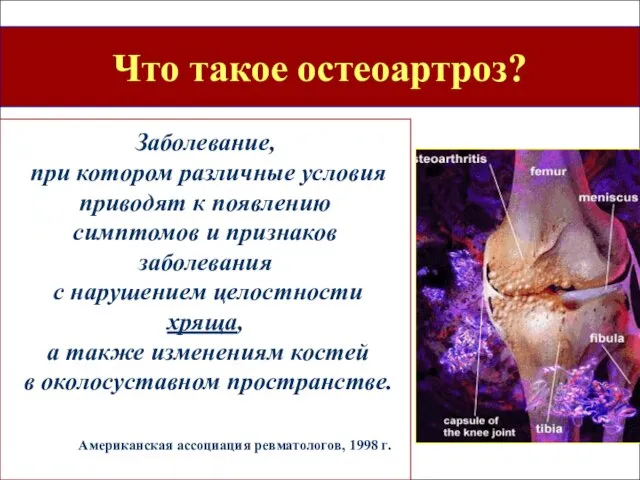 Что такое остеоартроз? Заболевание, при котором различные условия приводят к появлению симптомов