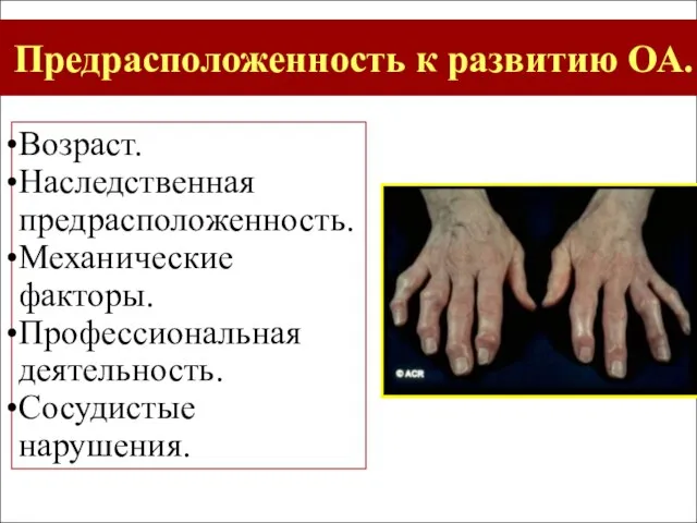 Возраст. Наследственная предрасположенность. Механические факторы. Профессиональная деятельность. Сосудистые нарушения. Предрасположенность к развитию ОА.