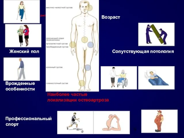 Причины и факторы риска развития остеоартроза Причины и факторы риска развития остеоартроза Наиболее частые локализации остеоартроза