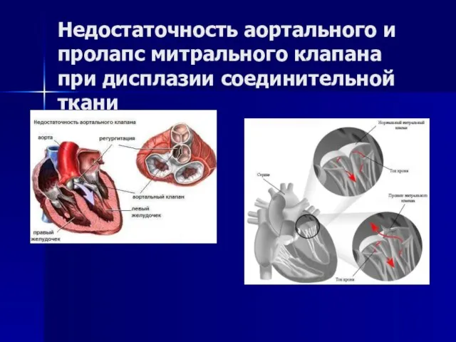 Недостаточность аортального и пролапс митрального клапана при дисплазии соединительной ткани