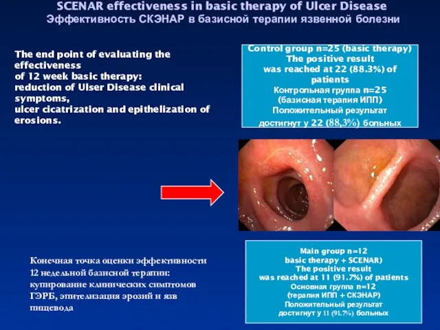 SCENAR effectiveness in basic therapy of Ulcer Disease Эффективность СКЭНАР в базисной