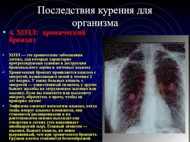 Последствия курения для организма 4. ХОЗЛ: хронический бронхит ХОЗЛ — это хронические