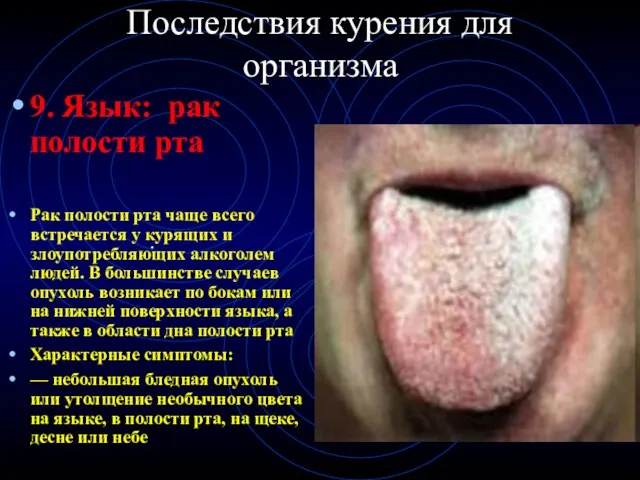 Последствия курения для организма 9. Язык: рак полости рта Рак полости рта