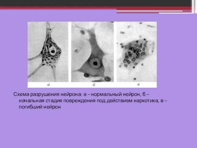 Схема разрушения нейрона: а – нормальный нейрон, б – начальная стадия повреждения