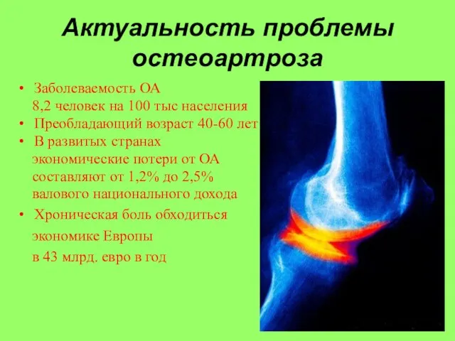 Актуальность проблемы остеоартроза Заболеваемость ОА 8,2 человек на 100 тыс населения Преобладающий