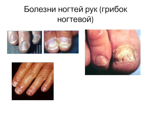Болезни ногтей рук (грибок ногтевой)