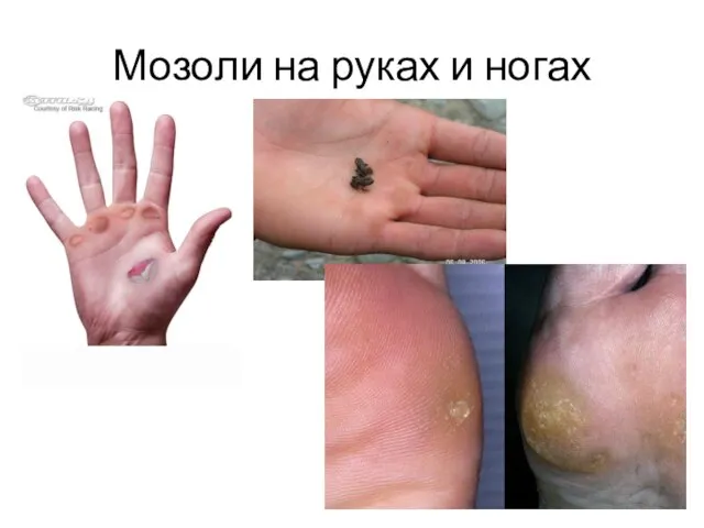 Мозоли на руках и ногах