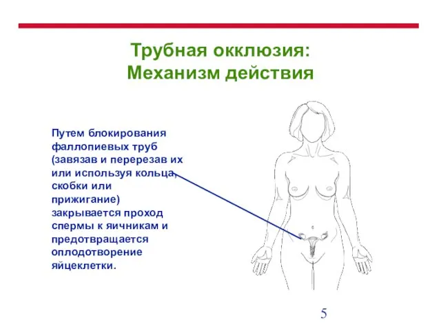 Трубная окклюзия: Механизм действия Путем блокирования фаллопиевых труб (завязав и перерезав их