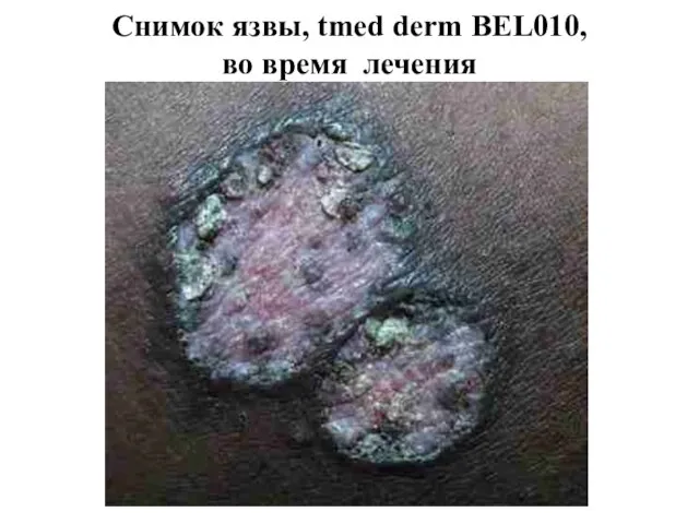 Снимок язвы, tmed derm BEL010, во время лечения