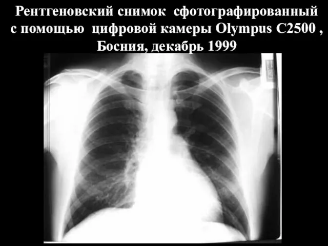 Рентгеновский снимок сфотографированный с помощью цифровой камеры Olympus C2500 , Босния, декабрь 1999